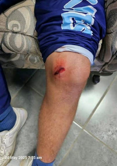 WhatsApp Image 2025-05-20 at 10.47.58_edc018a41 Student that has been bruised by the bullet of AK-47